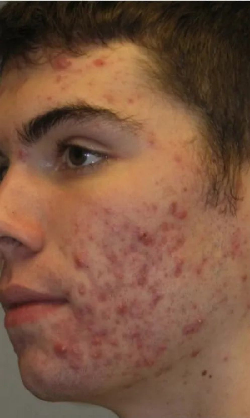 Before LED mask skin care result