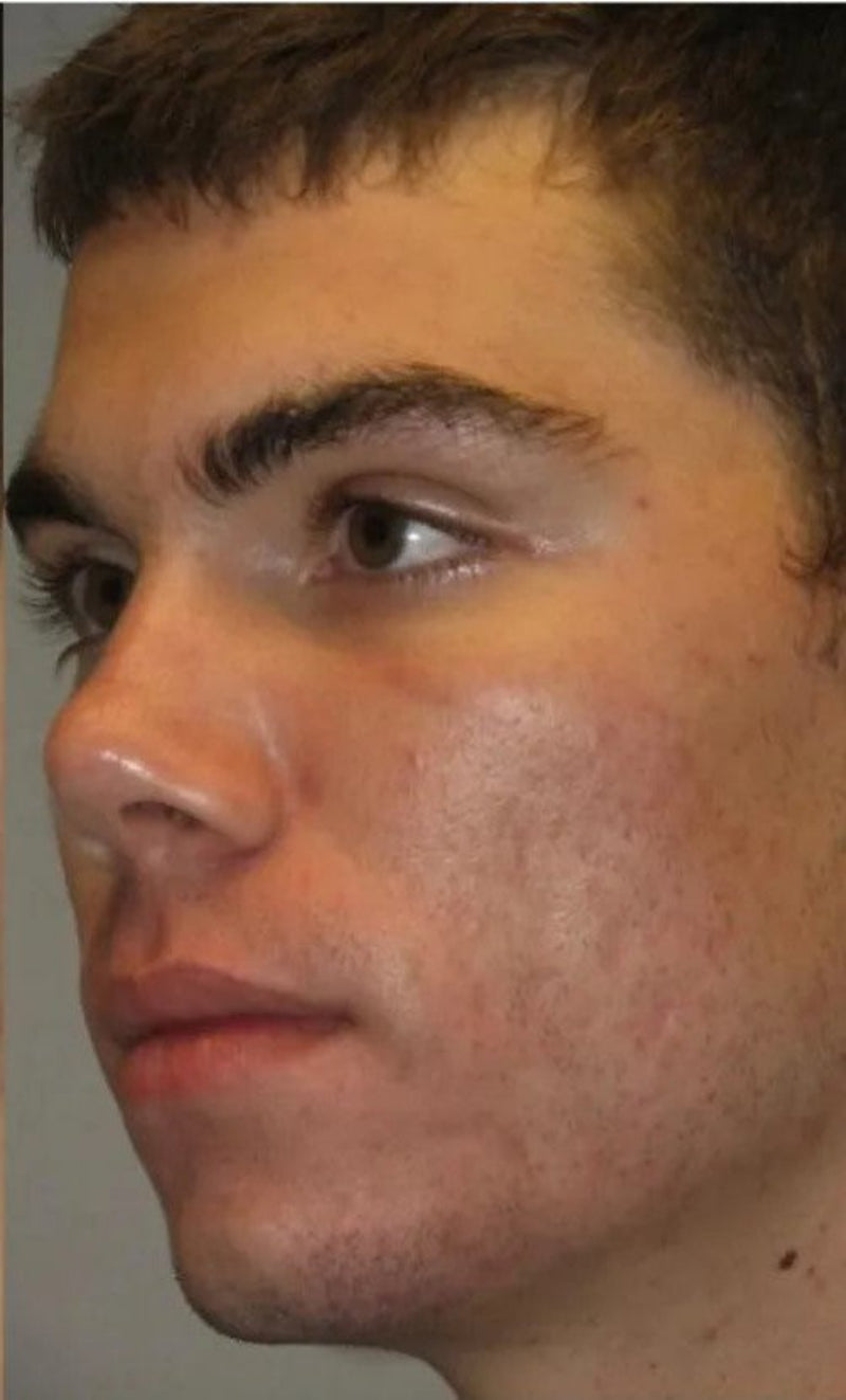 LED mask skin care result
